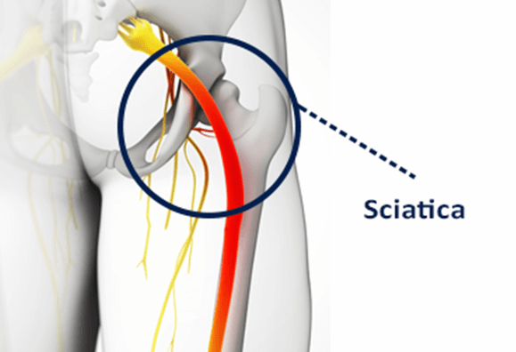 Sciatica