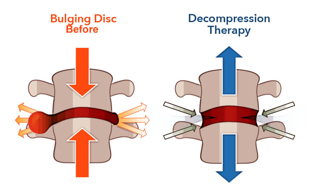 Spinal Decompression
